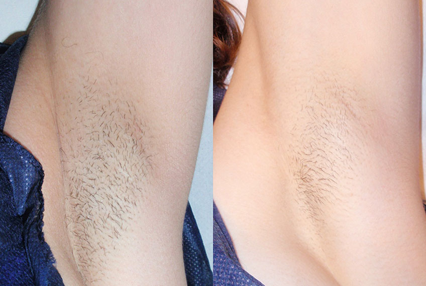 Vixen ® laser hair removal before & after 1 treatment.
