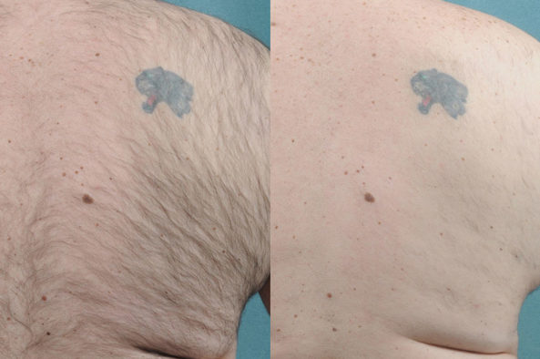 hair-removal_before-after3_large